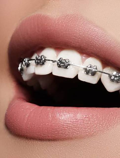 Woman’s mouth with traditional braces in Castle Rock