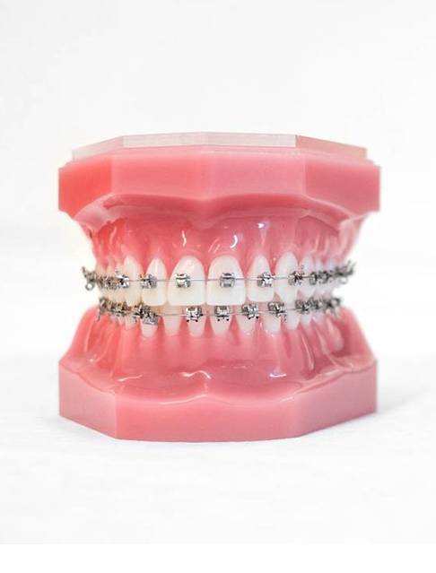 Model of teeth with traditional braces in Castle Rock