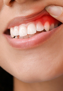Woman pulling back upper lip with one finger to reveal darkened gums
