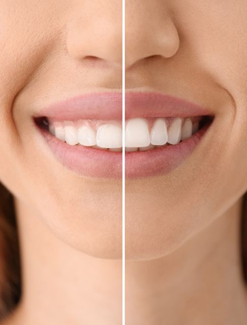 A CGI of gum recontouring treatment