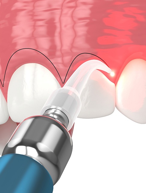A CGI of a gum recontouring procedure