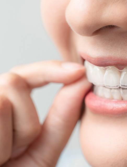 Closeup of patient putting on clear aligner