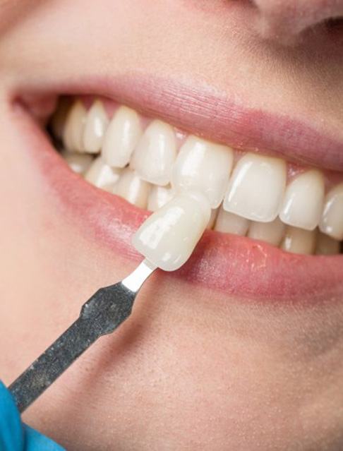 Dentist comparing a veneer to a patient’s natural teeth