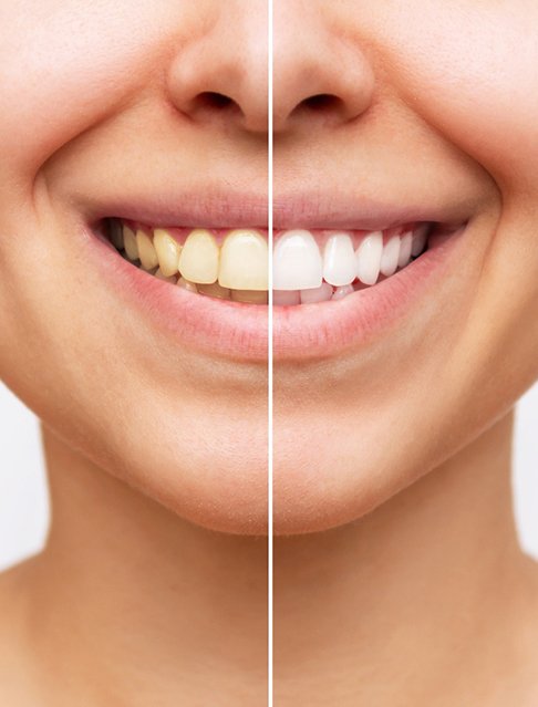 Closeup of patient's smile before and after teeth whitening